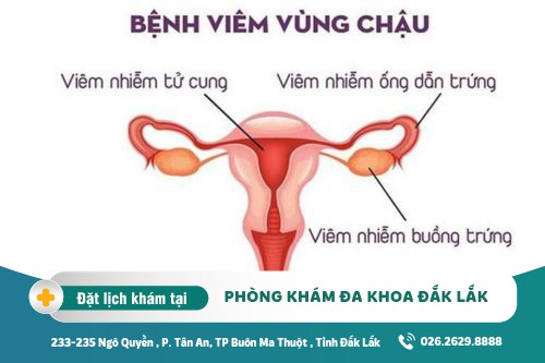 Cách trị viêm vùng chậu Đắk Lắk - Trị viêm vùng chậu hiệu quả bằng cách nào?