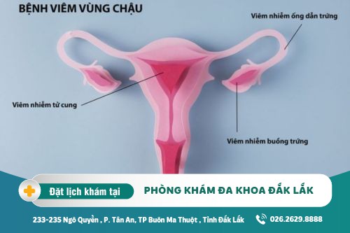 Chữa viêm vùng chậu Đắk Lắk - Nguyên nhân viêm vùng chậu là gì?