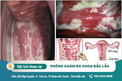 Chữa viêm âm đạo Đắk Lắk – Nguyên nhân gây viêm âm đạo là gì?