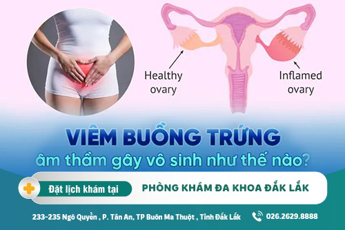 Chữa viêm buồng trứng Đắk Lắk – Viêm buồng trứng có nguy hiểm không?