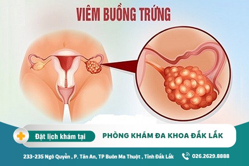 Trị viêm buồng trứng Đắk Lắk – Triệu chứng viêm buồng trứng là gì?